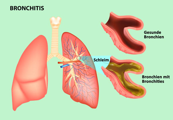 Therapeutische Anwendung eines Inhaliergeräts bei Bronchitis
