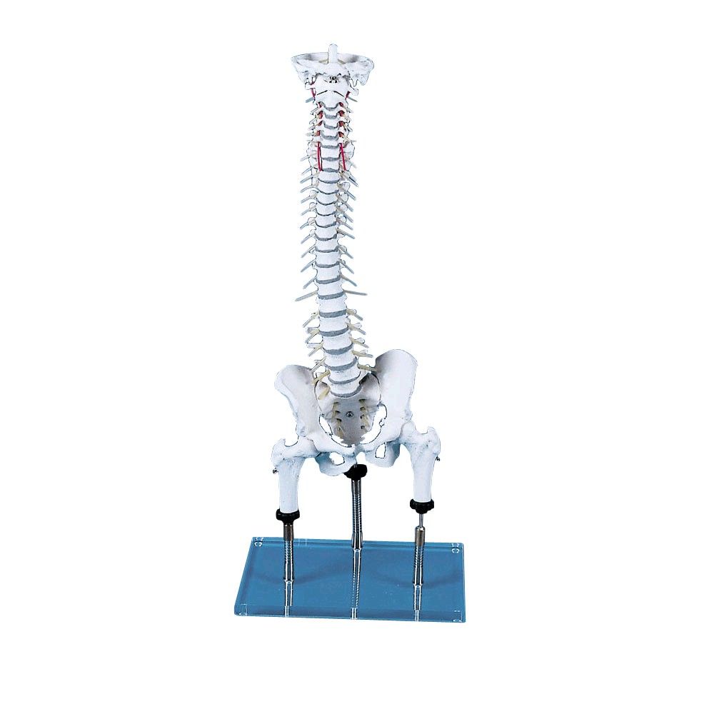 Anatomisches Modell von Wirbelsäule, Becken und Oberschenkeln mit markierter Fehlstellung
