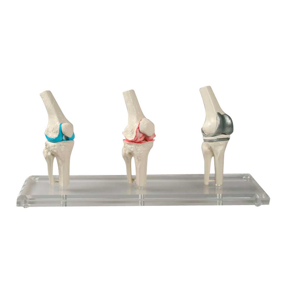 Knie-Implantat-Modell-Set mit drei Kniegelenk-Modellen auf transparenter Halterung