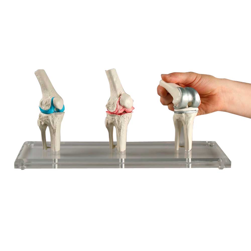Knie-Implantat-Modell mit zwei Kniegelenken und Hand beim Einsetzen eines Einsatzes